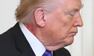 Zbliżenie na profil Donalda Trumpa, widoczna zaczerwieniona skóra na szyi, sugerująca, że trump chory.