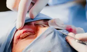 Blefaroplastyka górnych vs dolnych powiek – czym się różnią i kiedy je łączyć?
