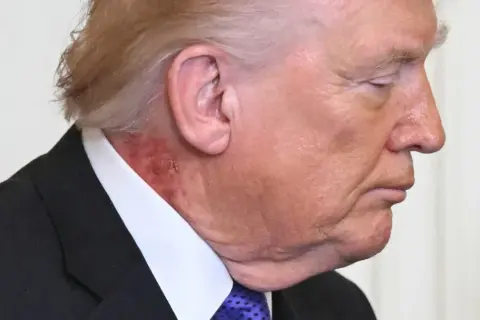 Zbliżenie na profil Donalda Trumpa, widoczna zaczerwieniona skóra na szyi, sugerująca, że trump chory.