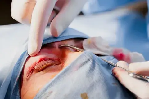 Blefaroplastyka górnych vs dolnych powiek – czym się różnią i kiedy je łączyć?