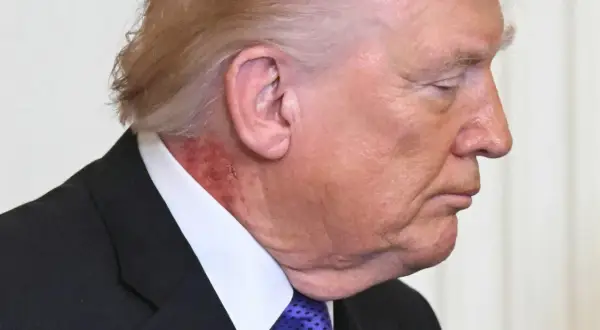 Zbliżenie na profil Donalda Trumpa, widoczna zaczerwieniona skóra na szyi, sugerująca, że trump chory.