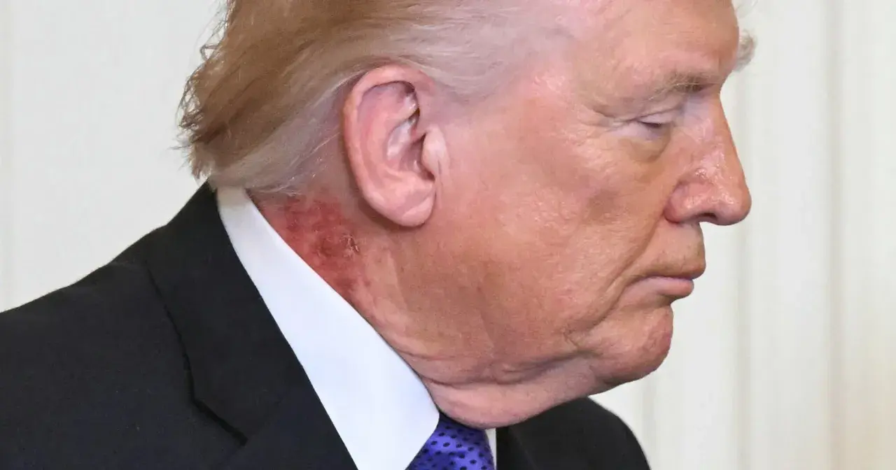 Zbliżenie na profil Donalda Trumpa, widoczna zaczerwieniona skóra na szyi, sugerująca, że trump chory.